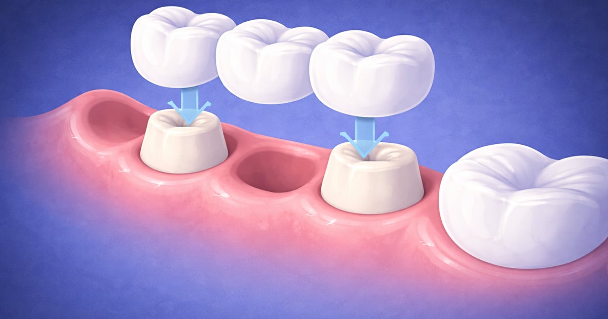 Bridges in Reno, NV | Silverado Family Dentistry