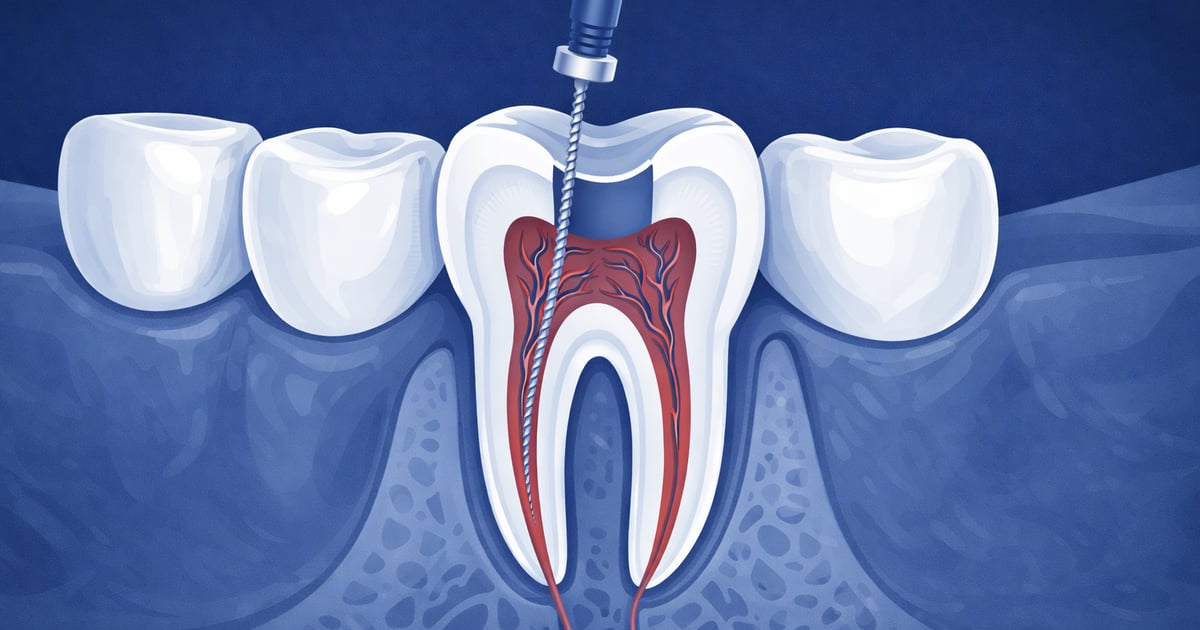 Endodoncia en Reno, NV | Silverado Family Dentistry